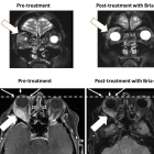 BriaCell Images Confirm Robust Anti-Tumor Activity in Patient with “Eye-Bulging” Metastatic Breast Cancer