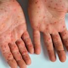 Kymera Therapeutics Says Atopic Dermatitis Potential Matches Sanofi/Regeneron's Blockbuster Dupixent In Early Biomarker Response
