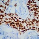 Full Arvinas, Pfizer data confirm potential and limits of ‘Protac’ drug in breast cancer