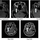 BriaCell Reports 100% Resolution of Brain Metastasis in Breast Cancer Patient with “Eye-Bulging” Tumor