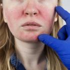 FDA approves Journey Medical’s rosacea treatment Emrosi