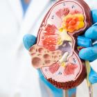 FDA places hold on Kezar Life Sciences’ trial for lupus nephritis treatment