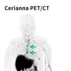 Updated NCCN Clinical Practice Guidelines in Oncology (NCCN Guidelines®) Recommend Use of FES PET Imaging for Lobular Breast Cancer