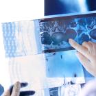 CNSide Diagnostics reports data from trial of CNSide CSF Assay in LM diagnosis