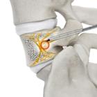 Stryker receives FDA clearance for OptaBlate® BVN Basivertebral Nerve Ablation System