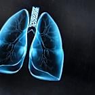ASCO 2025: DeLLphi-304 helps Amgen to pave the way for BiTEs in solid cancers