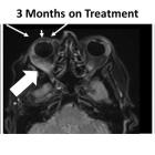 BriaCell Quadruples Progression Free Survival (PFS) in Patient with “Eye-Bulging” Metastatic Breast Cancer