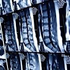 Stryker wins FDA clearance for minimally invasive back pain treatment