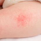 First child enrolled in Arcutis’ Phase II trial of cream for atopic dermatitis