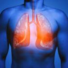 KRYS Reports Upbeat Initial Data From Lung Cancer Study of KB707