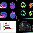 Journal of Clinical Nuclear Medicine Publishes Results of Tiziana’s Nasal Foralumab in Study Treating Moderate Alzheimer's Disease