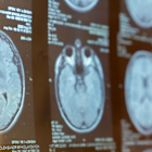 Immunic presses ahead with MS drug despite Phase II endpoint miss