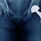 Zimmer pulls hip implant off the market due to fracture risk