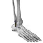 Paragon 28 Launches the Phantom® Fibula Nail System for Less Invasive Fracture Repair