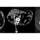 IceCure System Successfully Treated Kidney Cancer Tumor with 92% Disease-Free Survival Rate and 100% Secondary Local Control Rate