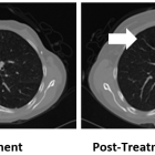 BriaCell Announces Resolution of Lung Metastasis in First Patient treated with Bria-OTS™