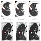 BriaCell Confirms 100% Resolution of Lung Metastasis with Bria-OTS™