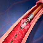 BD to launch registry study of atherectomy system for PAD treatment