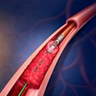 BD to Initiate Real-World Patient Data Registry for the Rotarex™ Atherectomy System in Treatment of Peripheral Artery Disease