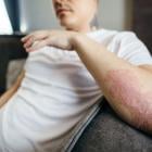 Psoriasis biosimilars and pricing changes herald treatment paradigm disruptions