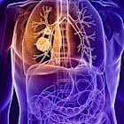 FDA clears Nuvation lung cancer drug, setting up battle with Bristol Myers and Roche