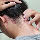 J&J reports new data from Phase III trial of icotrokinra for plaque psoriasis