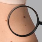 ASCO25: Regeneron unpacks positive Libtayo data in adjuvant CSCC as Keytruda stumbles