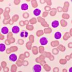 Nurix Therapeutics’ NX-5948 shows promise in Waldenstrom’s macroglobulinaemia trial