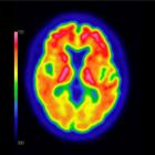 FDA Approves Expanded Indications for GE HealthCare’s Vizamyl PET Imaging Agent for Beta Amyloid Detection, Enabling More Precise Care for Alzheimer’s Patients