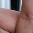 FDA reviews Sanofi and Regeneron’s Dupixent label expansion for urticaria