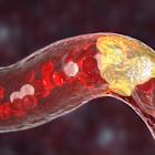 Ionis reports success in olezarsen trial for high triglycerides