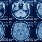 Boston Scientific secures CE mark for Deep Brain Stimulation software