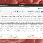 CeriBell IPO: Stock price soars as AI brain-monitoring headband maker debuts on Nasdaq