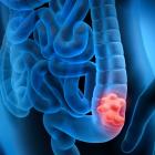 Johnson & Johnson seeks FDA approval for Tremfya for Crohn’s disease
