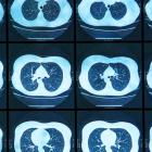 TIGIT drug from iTeos shrinks lung tumors in trial