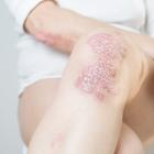Alumis concludes enrolment in Phase III programme of plaque psoriasis therapy
