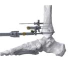 Paragon 28 launches new ‘Right-Angle Drill’ for ankle replacements