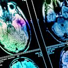 Stroke Management Drug Firm Climbs To Key Level Ahead Of Earnings; But Beware This Pharma Tariff