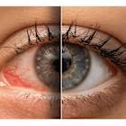 Eyes On Park Introduces Revolutionary Envision by InMode System for Advanced Dry Eye Treatment in New York City