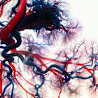 Penumbra may gain market share in peripheral embolisation coils with Ruby XL