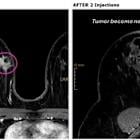 Intensity Therapeutics, Inc. Announces Patients Receiving INT230-6 Prior to the Start of Standard-of-Care May Achieve High Levels of Tumor Necrosis in the Ongoing Randomized Controlled Phase 2 INVINCIBLE-4 Study