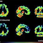 Tiziana Life Sciences Announces Significant Reduction in Microglia Activation in PET Scan of Moderate Alzheimer's Patient Treated with Intranasal Foralumab