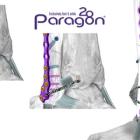 Paragon 28 Adds to Suite of Novel Syndesmosis Repair Solutions with Launch of Grappler® R3INFORCE™ Extraosseous Repair System